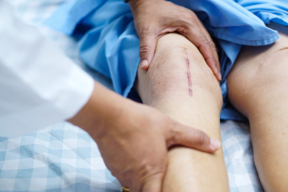 Physical Therapy After Knee Replacement in Visalia - Bacci & Glinn Physical  Therapy
