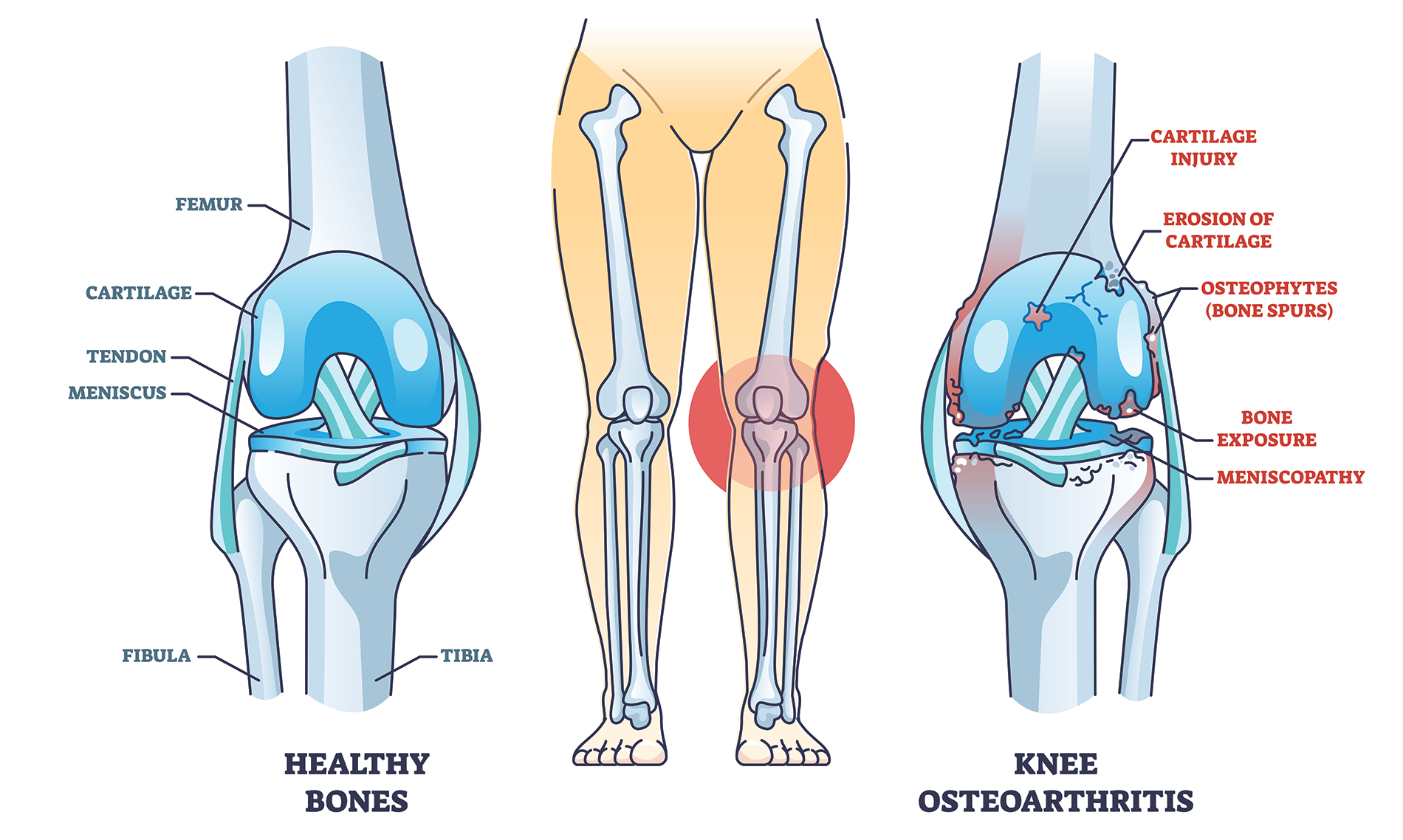 knee arthritis treatment in Hanford